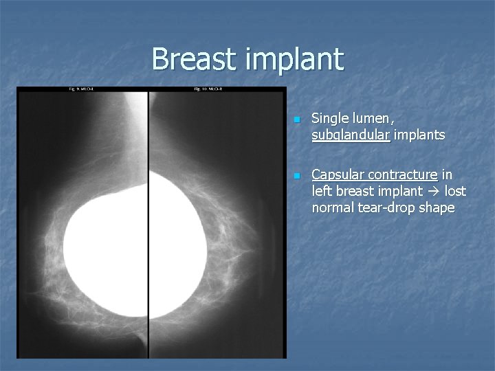 Breast implant n n Single lumen, subglandular implants Capsular contracture in left breast implant