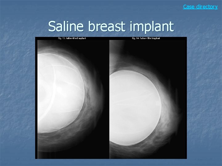 Case directory Saline breast implant 