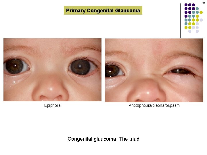 19 Primary Congenital Glaucoma Epiphora Photophobia/blepharospasm Congenital glaucoma: The triad 