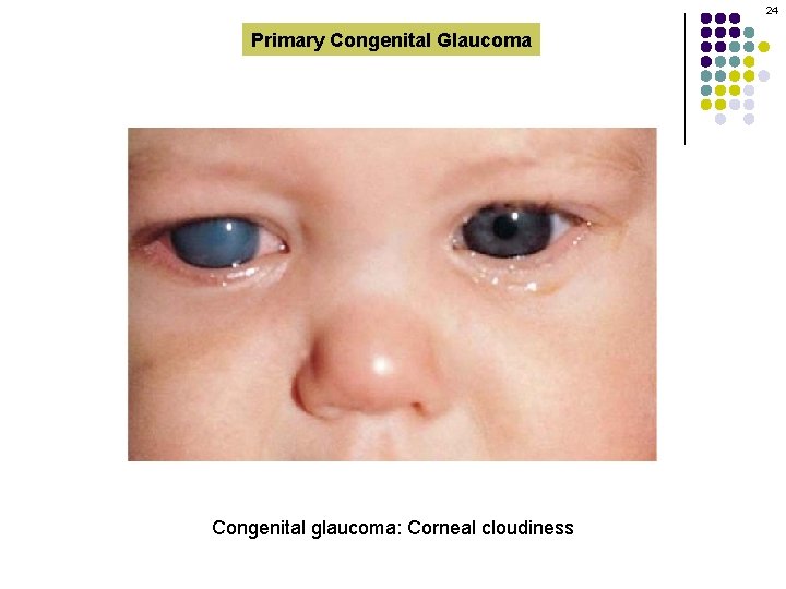 24 Primary Congenital Glaucoma Congenital glaucoma: Corneal cloudiness 