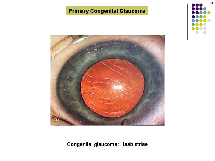 29 Primary Congenital Glaucoma Congenital glaucoma: Haab striae 