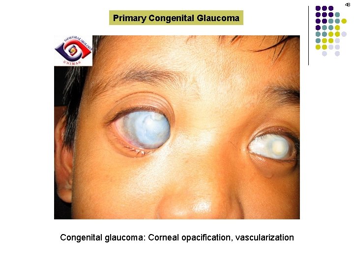48 Primary Congenital Glaucoma Congenital glaucoma: Corneal opacification, vascularization 
