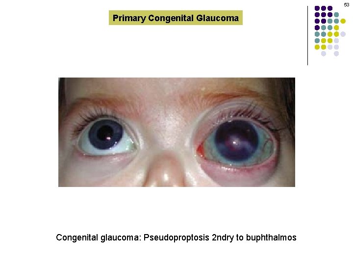 glaucom congenital