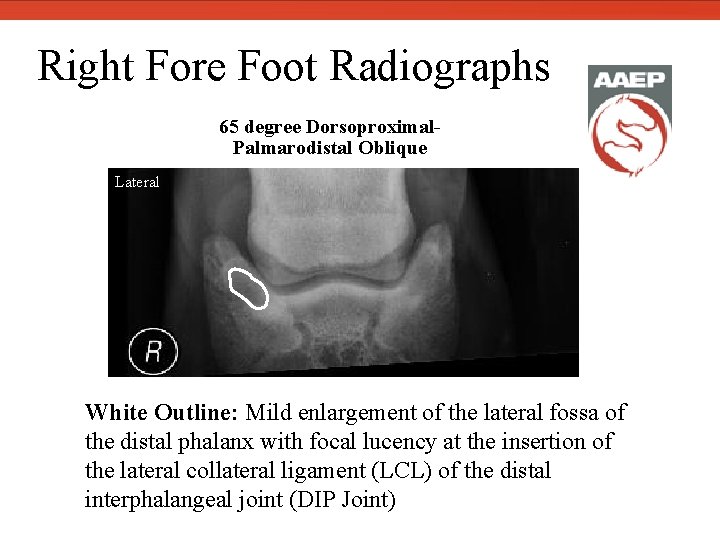 Right Fore Foot Radiographs 65 degree Dorsoproximal. Palmarodistal Oblique Lateral White Outline: Mild enlargement