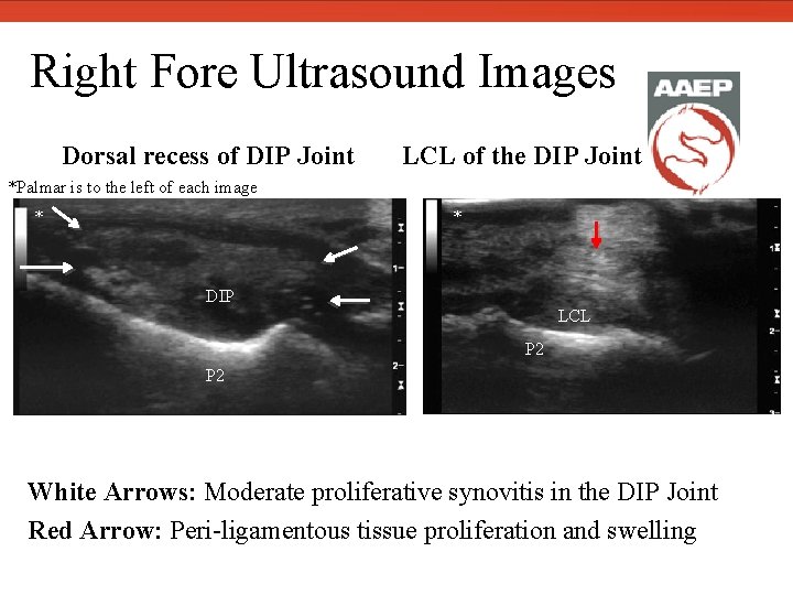  Right Fore Ultrasound Images Dorsal recess of DIP Joint LCL of the DIP