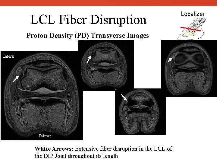  LCL Fiber Disruption Proton Density (PD) Transverse Images Lateral Palmar White Arrows: Extensive