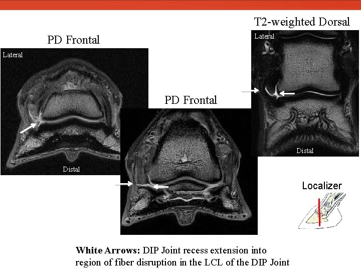 T 2 -weighted Dorsal Lateral PD Frontal Distal Localizer White Arrows: DIP Joint recess