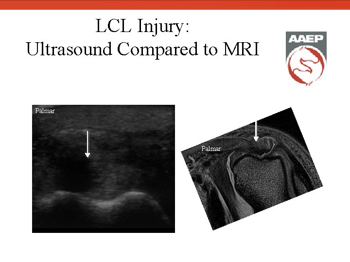  LCL Injury: Ultrasound Compared to MRI Palmar 