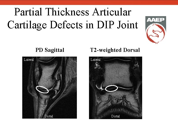 Partial Thickness Articular Cartilage Defects in DIP Joint PD Sagittal Lateral T 2 -weighted