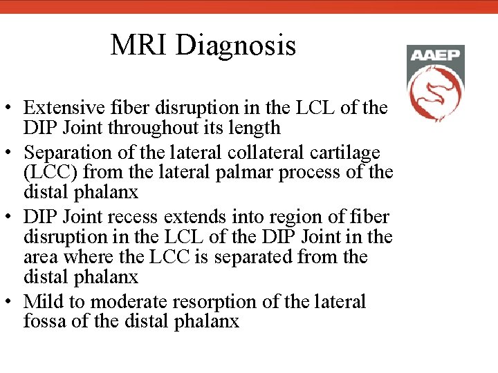  MRI Diagnosis • Extensive fiber disruption in the LCL of the DIP Joint