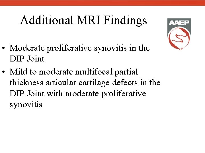  Additional MRI Findings • Moderate proliferative synovitis in the DIP Joint • Mild
