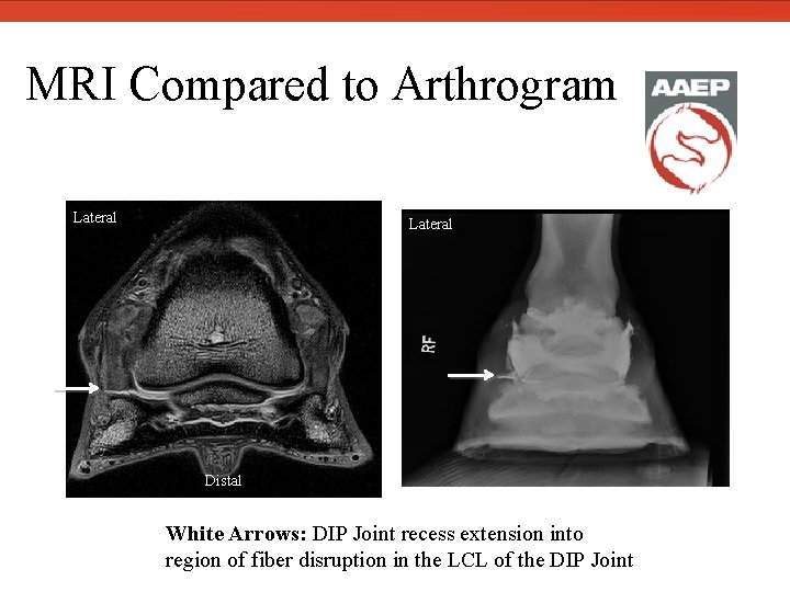  MRI Compared to Arthrogram Lateral Distal White Arrows: DIP Joint recess extension into