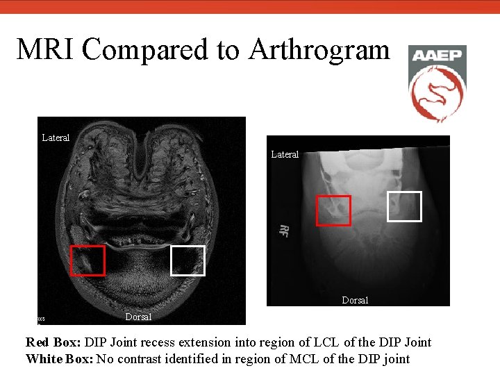  MRI Compared to Arthrogram Lateral Dorsal Red Box: DIP Joint recess extension into