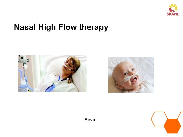 Nasal High Flow therapy Airvo 