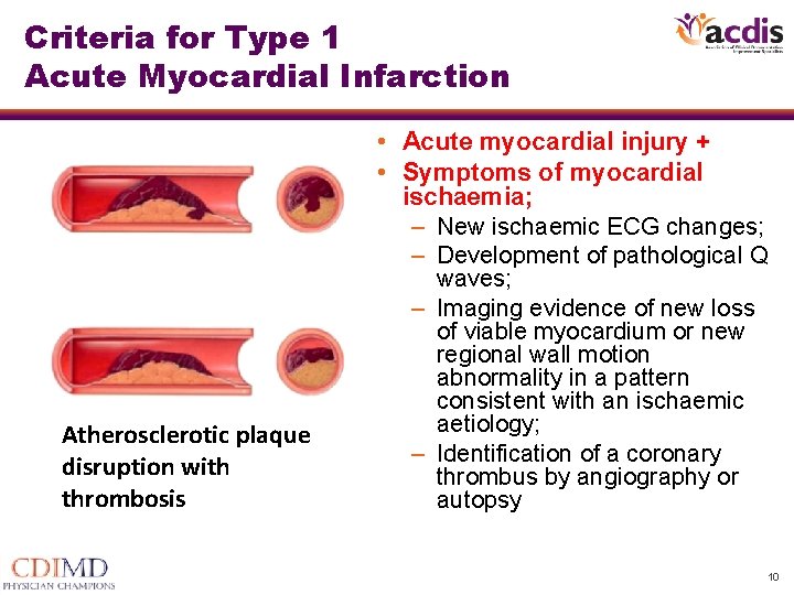 Criteria for Type 1 Acute Myocardial Infarction • Acute myocardial injury + • Symptoms Criteria for Type 1 Acute Myocardial Infarction • Acute myocardial injury + • Symptoms