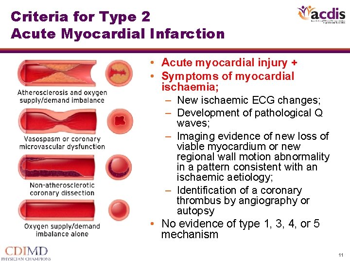 Criteria for Type 2 Acute Myocardial Infarction • Acute myocardial injury + • Symptoms Criteria for Type 2 Acute Myocardial Infarction • Acute myocardial injury + • Symptoms