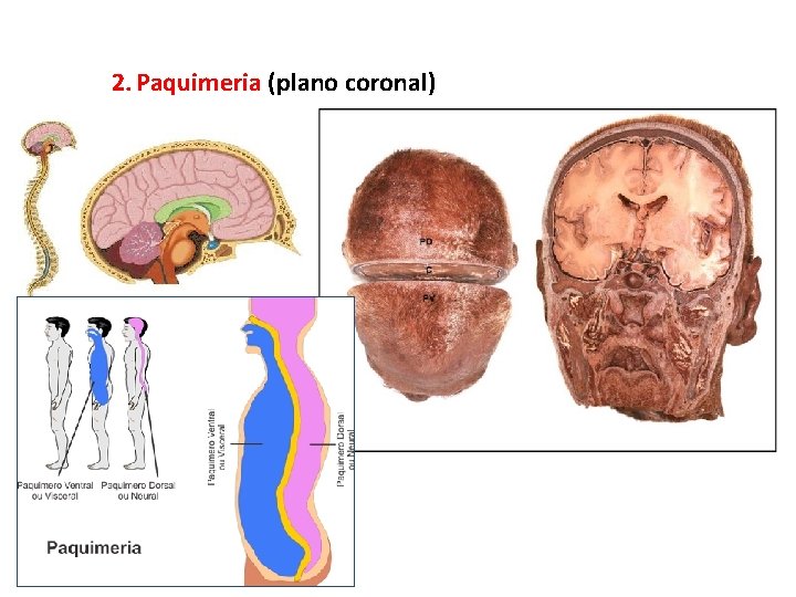 2. Paquimeria (plano coronal) 