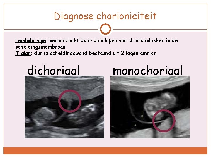 Diagnose chorioniciteit Lambda sign: veroorzaakt doorlopen van chorionvlokken in de scheidingsmembraan T sign: dunne