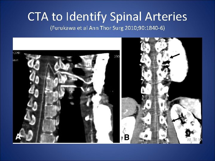 CTA to Identify Spinal Arteries (Furukawa et al Ann Thor Surg 2010; 90: 1840
