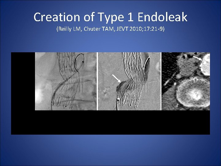 Creation of Type 1 Endoleak (Reilly LM, Chuter TAM, JEVT 2010; 17: 21 -9)