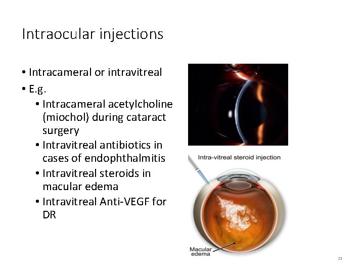 Intraocular injections • Intracameral or intravitreal • E. g. • Intracameral acetylcholine (miochol) during