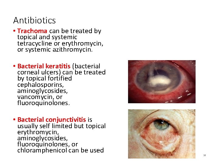 Antibiotics • Trachoma can be treated by topical and systemic tetracycline or erythromycin, or