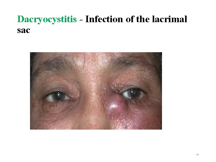 Dacryocystitis - Infection of the lacrimal sac 37 