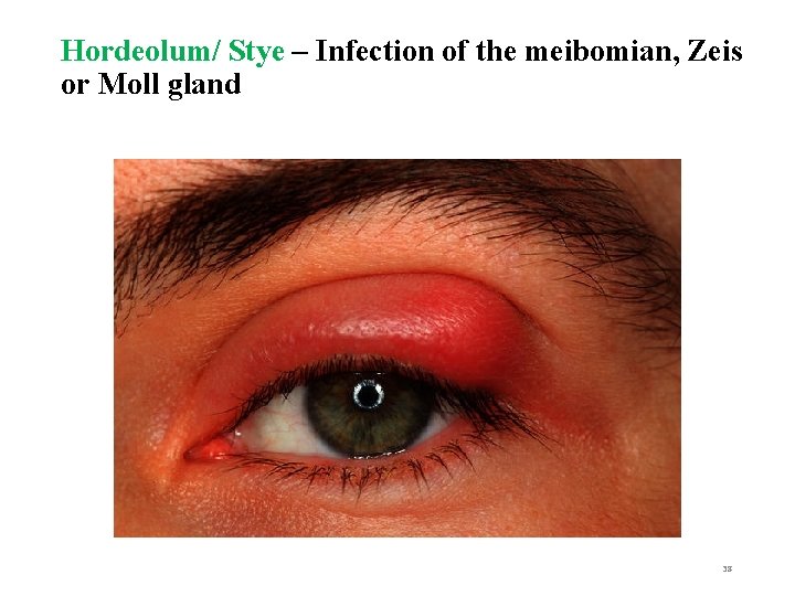 Hordeolum/ Stye – Infection of the meibomian, Zeis or Moll gland 38 