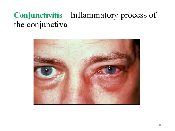 Conjunctivitis – Inflammatory process of the conjunctiva 39 
