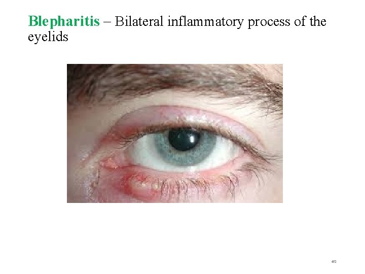 Blepharitis – Bilateral inflammatory process of the eyelids 40 