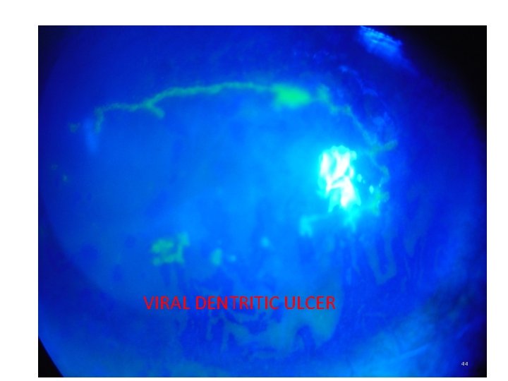 VIRAL DENTRITIC ULCER 44 