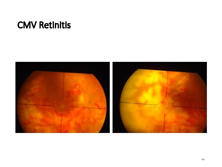 CMV Retinitis 45 