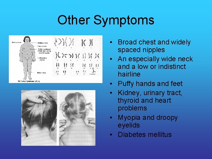 Other Symptoms • Broad chest and widely spaced nipples • An especially wide neck