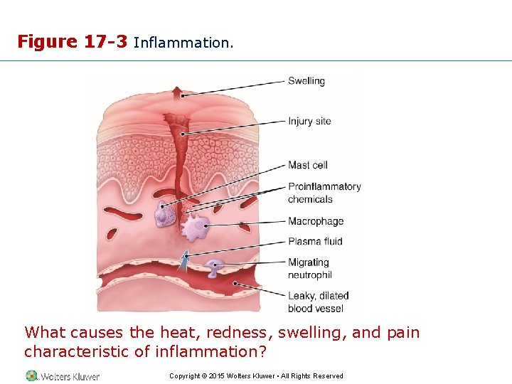 Figure 17 -3 Inflammation. What causes the heat, redness, swelling, and pain characteristic of