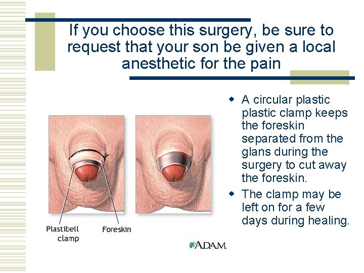 If you choose this surgery, be sure to request that your son be given