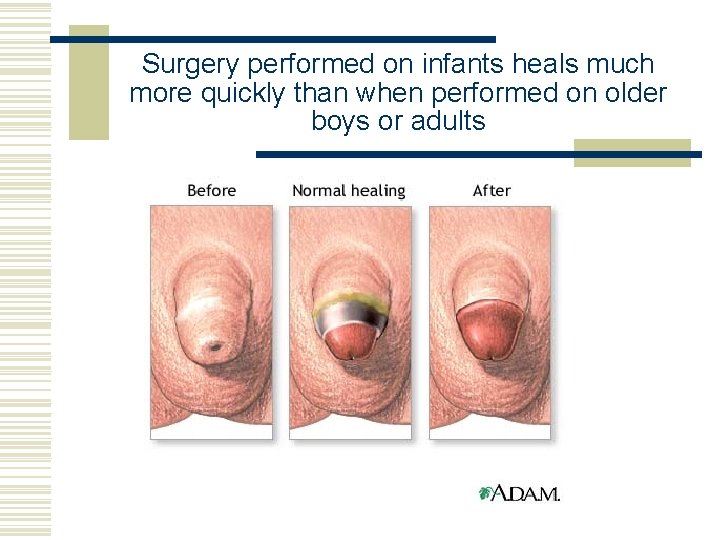 Surgery performed on infants heals much more quickly than when performed on older boys