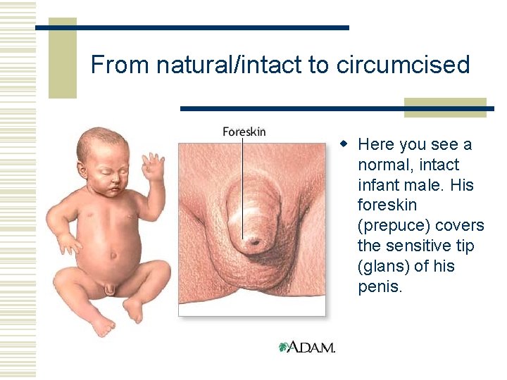 From natural/intact to circumcised w Here you see a normal, intact infant male. His