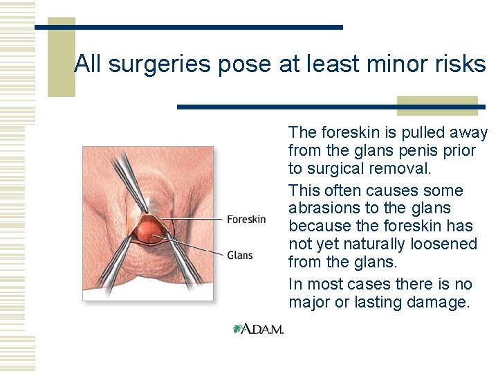 All surgeries pose at least minor risks w The foreskin is pulled away from