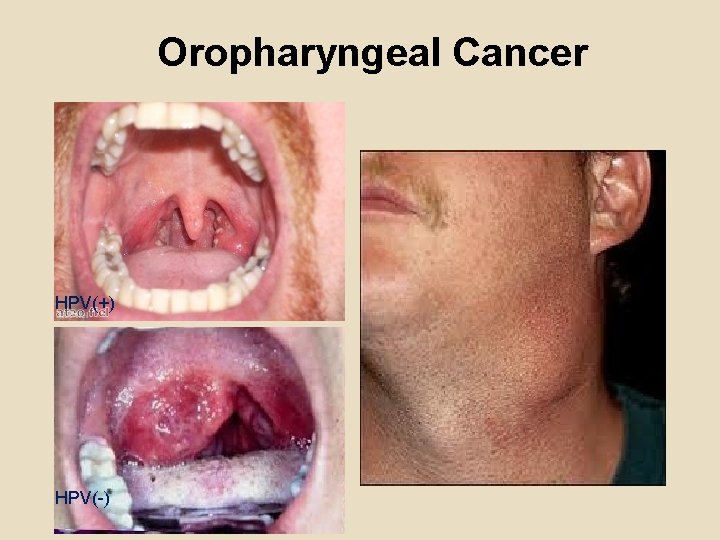 Oropharyngeal Cancer HPV(+) HPV(-) 