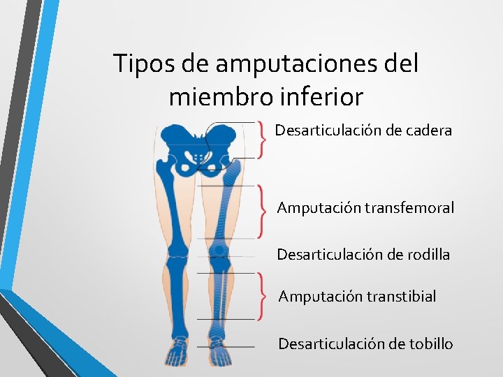 Tipos de amputaciones del miembro inferior Desarticulación de cadera Amputación transfemoral Desarticulación de rodilla