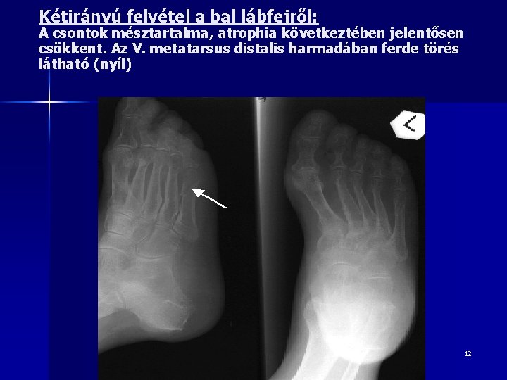 Kétirányú felvétel a bal lábfejről: A csontok mésztartalma, atrophia következtében jelentősen csökkent. Az V.