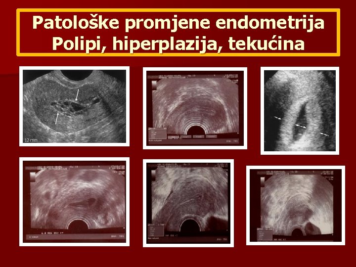 Patološke promjene endometrija Polipi, hiperplazija, tekućina 
