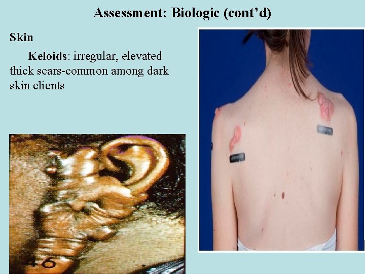 Assessment: Biologic (cont’d) Skin Keloids: irregular, elevated thick scars-common among dark skin clients 