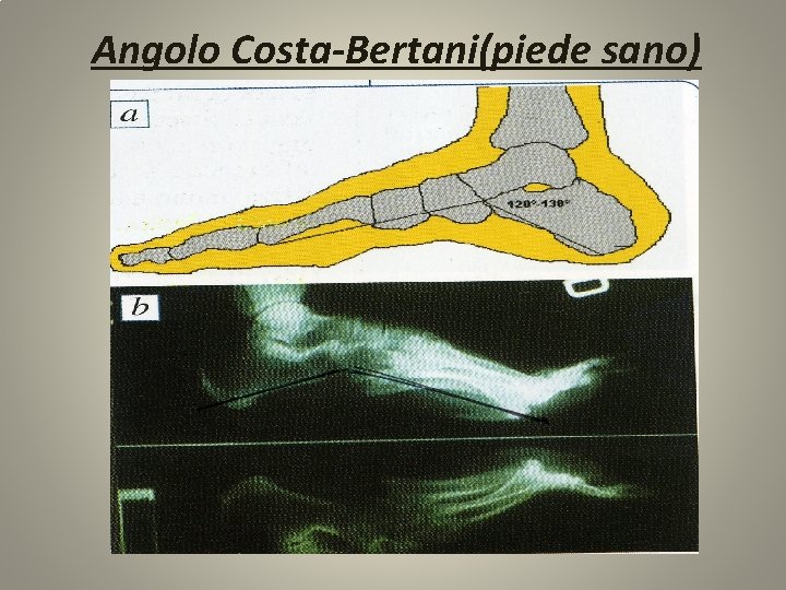 Angolo Costa-Bertani(piede sano) 