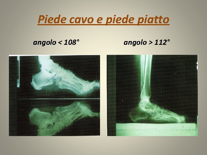 Piede cavo e piede piatto angolo < 108° angolo > 112° 