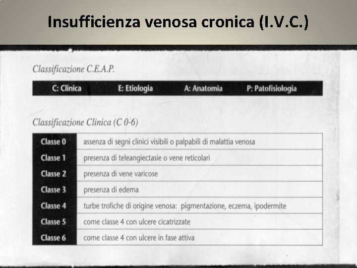 Insufficienza venosa cronica (I. V. C. ) 
