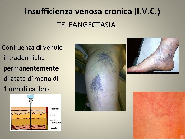 Insufficienza venosa cronica (I. V. C. ) TELEANGECTASIA Confluenza di venule intradermiche permanentemente dilatate