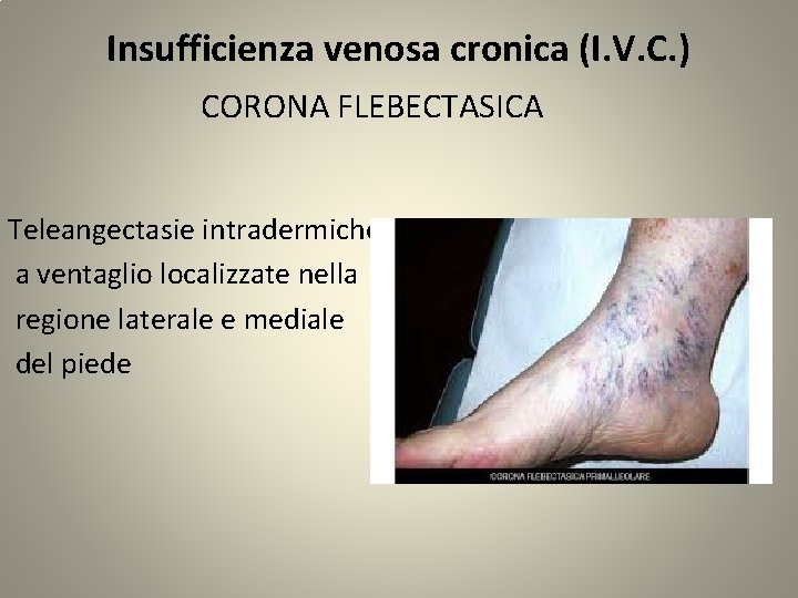 Insufficienza venosa cronica (I. V. C. ) CORONA FLEBECTASICA Teleangectasie intradermiche a ventaglio localizzate