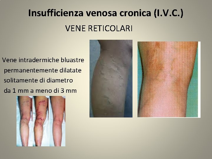 Insufficienza venosa cronica (I. V. C. ) VENE RETICOLARI Vene intradermiche bluastre permanentemente dilatate