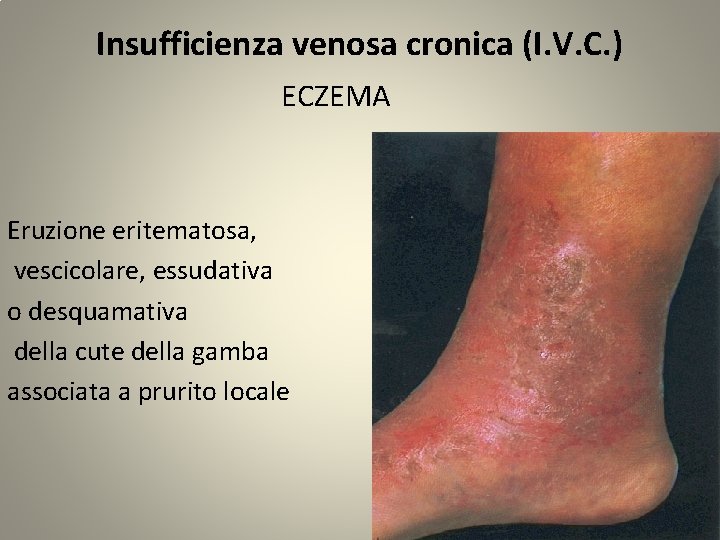 Insufficienza venosa cronica (I. V. C. ) ECZEMA Eruzione eritematosa, vescicolare, essudativa o desquamativa